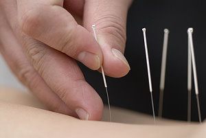 Eine Akupunktur Behandlung